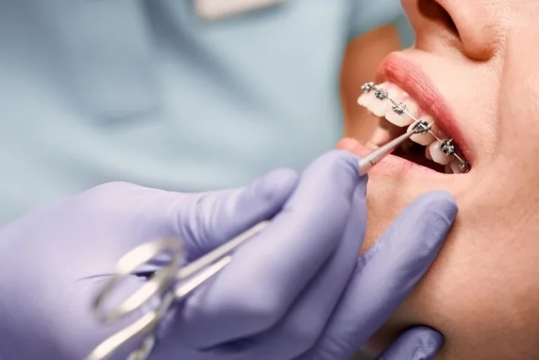 Affordable-Dental-Braces-in-Turkey-Types-Cost