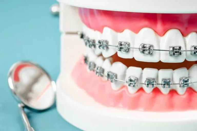 Affordable Dental Braces in Turkey Types, Cost & Expert Orthodontic Care Abroad