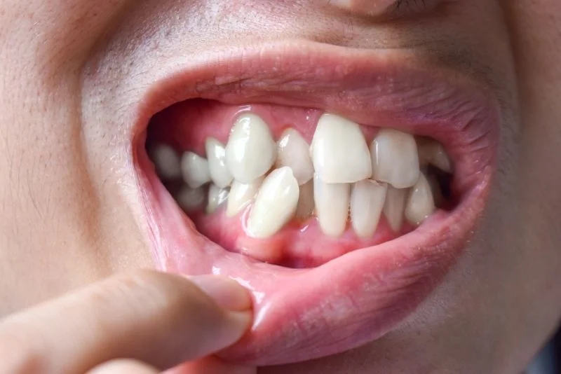 Affordable-Dental-Braces-in-Turkey