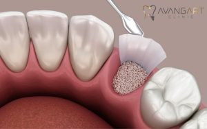 Bone Graft For Dental Implant: Process, Purpose & Risks
