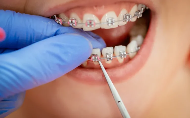 Braces Cost