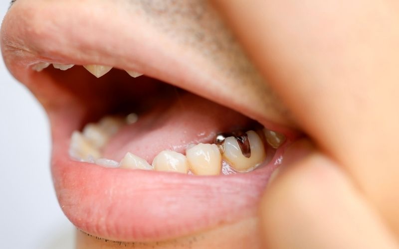 7 Yaygın Diş Kronu Sorunu ve Bunların Ekonomik Olarak Nasıl Giderileceği