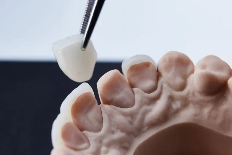 emax crowns applied