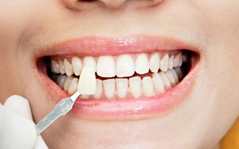 dental-Veneers-applied
