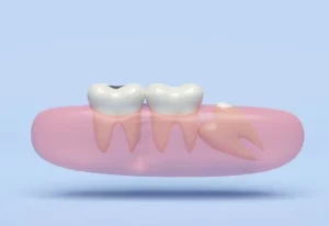 Wisdom Teeth Recovery Timeline: A Day By Day Ultimate Guide