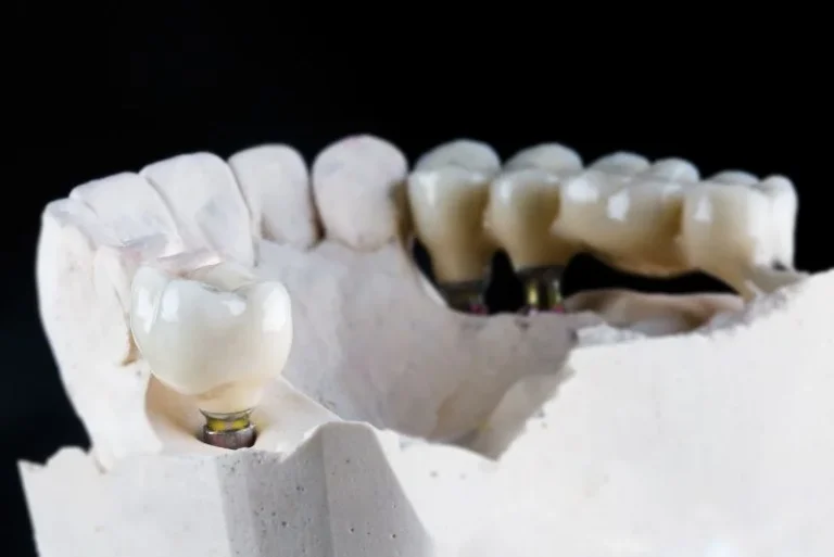 implant-supported-bridge