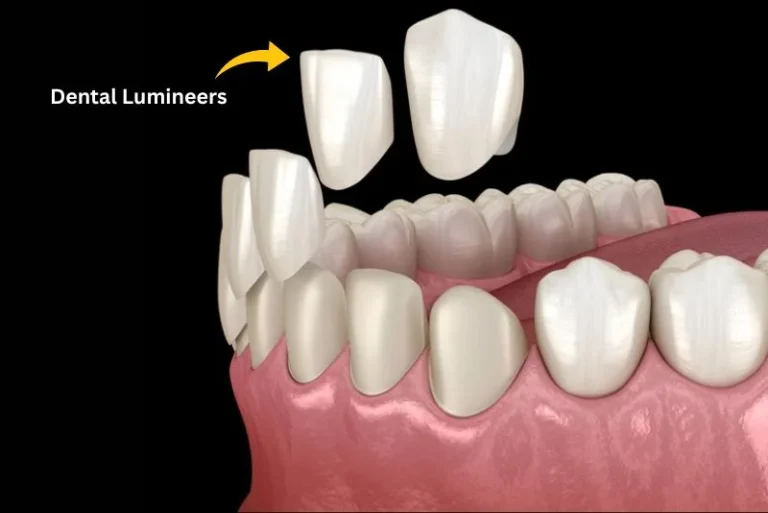 Dental Lumineers In Turkey