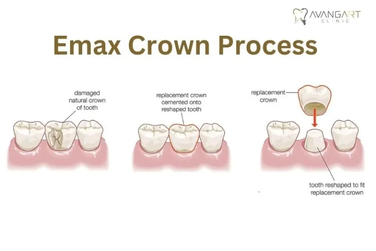 Emax-Crown-Process