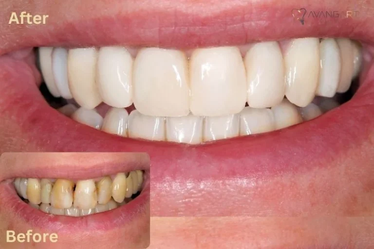 Emax-veneers-before-after