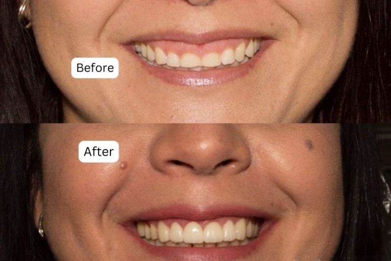 Gum Contouring Before After
