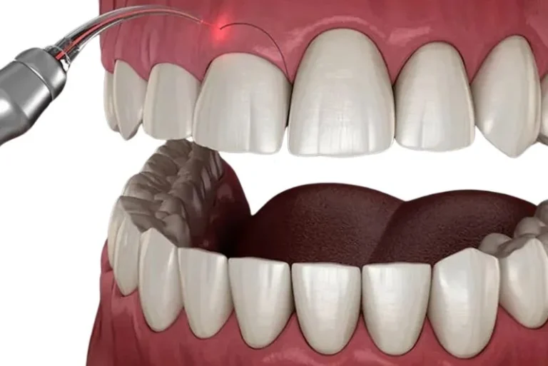 Gum-Contouring-Cost