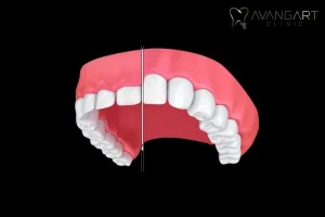 How Much Does Gingivectomy Cost?