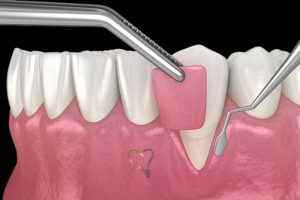 Gum Graft Alternatives: Modern Options for Healthier Gums