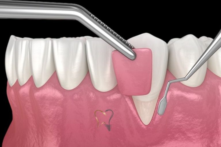 Gum Graft Alternatives