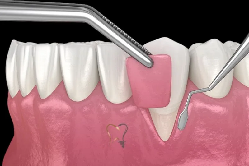 Gum Graft Alternatives: Modern Options for Healthier Gums