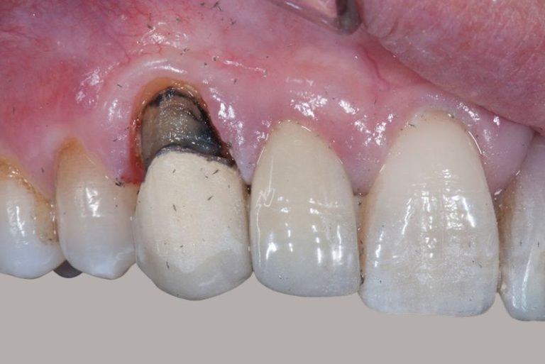 Gum Graft Failed