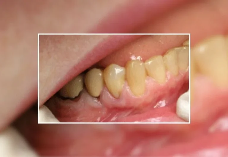 Gum-Graft-Failed-visual-Guide