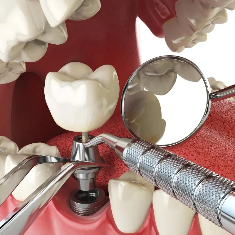 History-of-Dental-implants