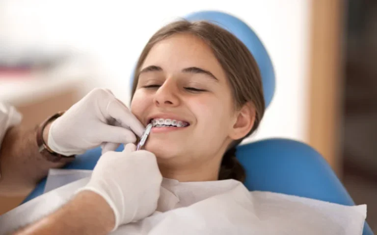 How braces work?
