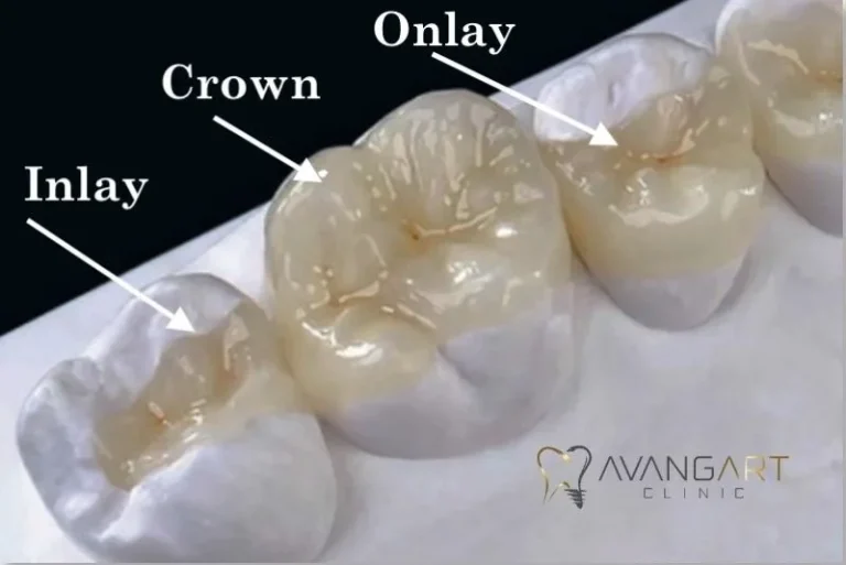 Inlays And Onlays Cost in Turkey