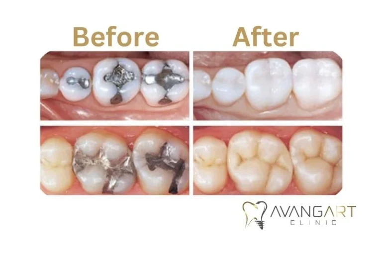 Inlays And Onlays Turkey before after