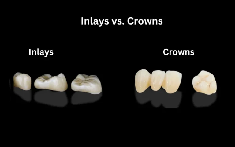 Inlays vs. Crowns