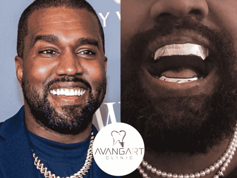 Kanye West Teeth Grill