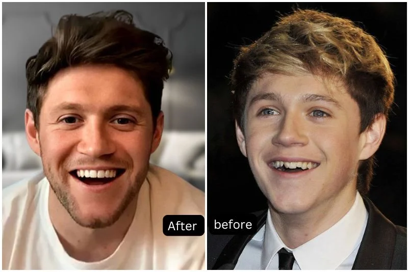 Nial Horan Celebrity Veneers Before and After