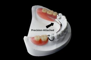 Precision-Attached Partial Dentures