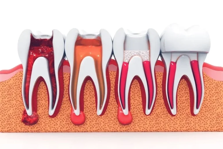 Root-Canal-Turkey-stages