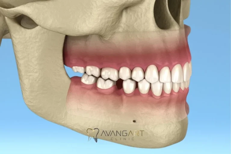 Signs-Your-Teeth-Are-Shifting