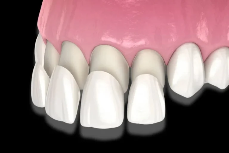 Teeth Covering Types, Cost, Procedure & Advantages