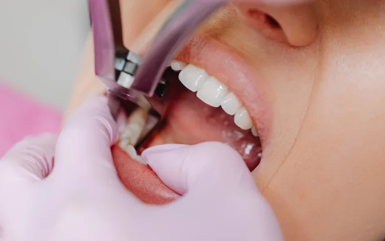 Tooth Extraction