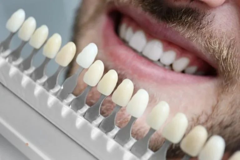 veneers samples