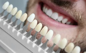 What Are Veneers Made Of?