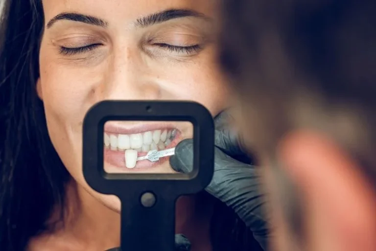 What-Are-Veneers-Made-Of-Material-Types
