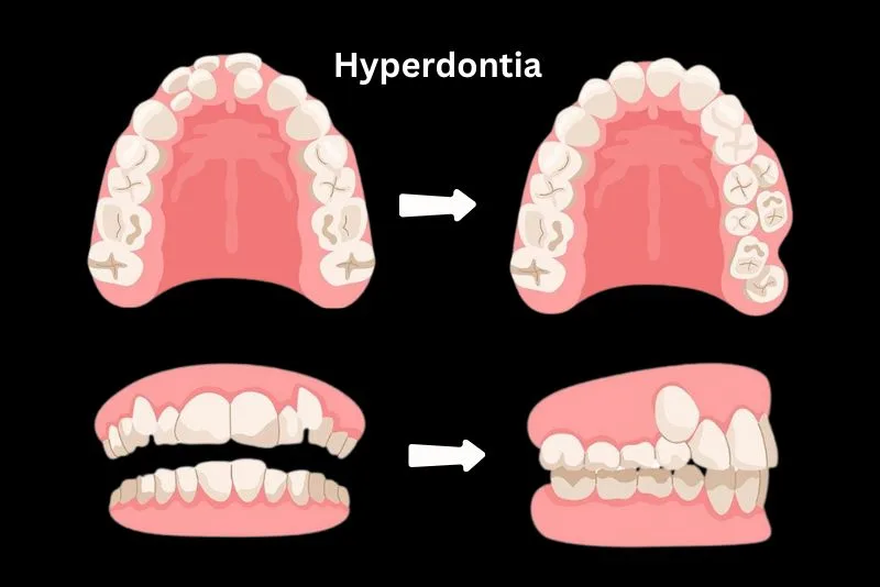 What Causes Hyperdontia? (Genetics, Syndromes, and Treatments)