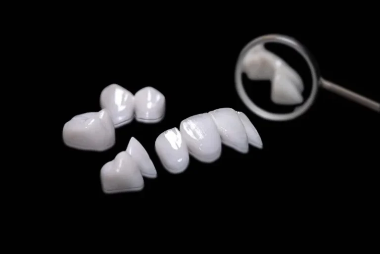 What is Dental Lumineers