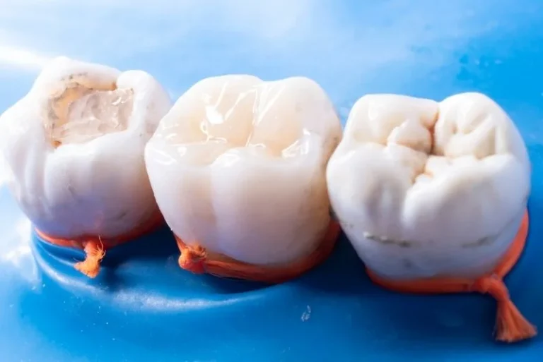 When is a Dental Filling Necessary