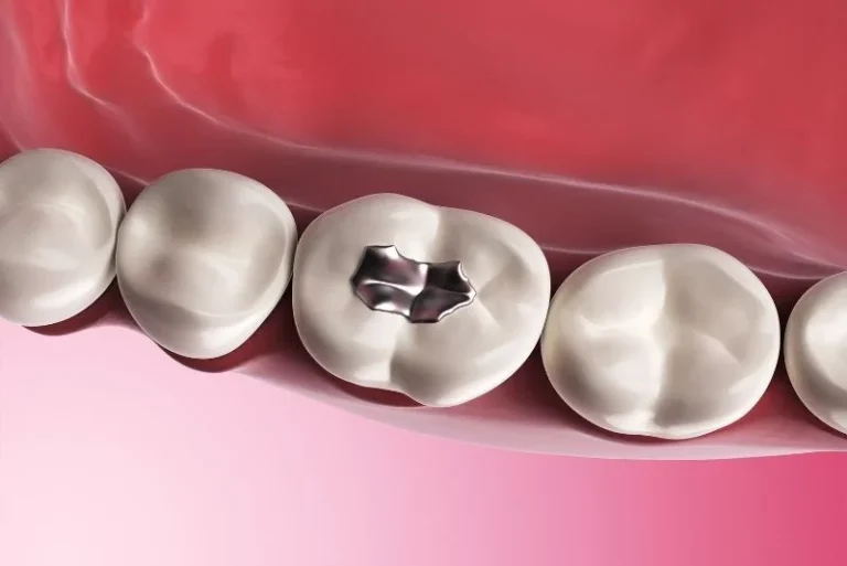When is a Dental Filling Necessary