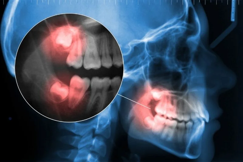 Wisdom-Teeth-pain