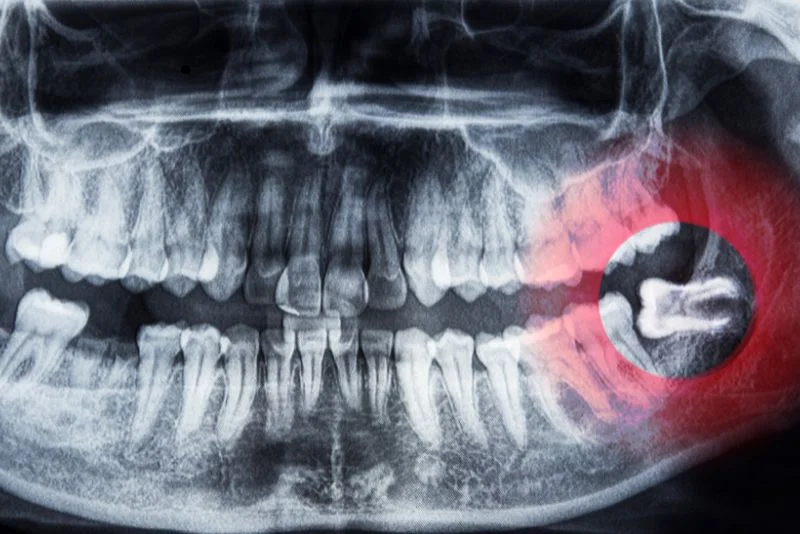 Xray-Wisdom-Teeth