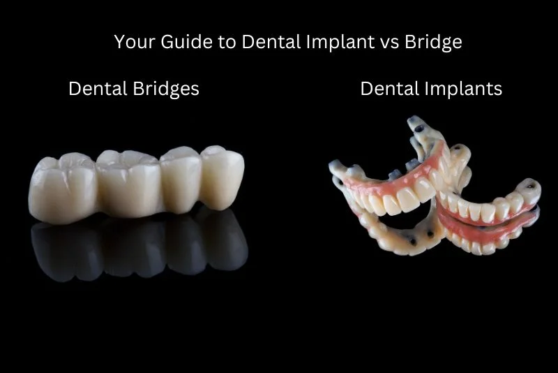Dental Implant vs. Bridge: Which Option Suits You Best?