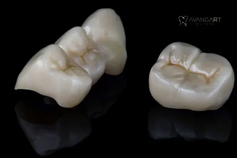 Zicronium-Crowns-Turkey-Final-Shape