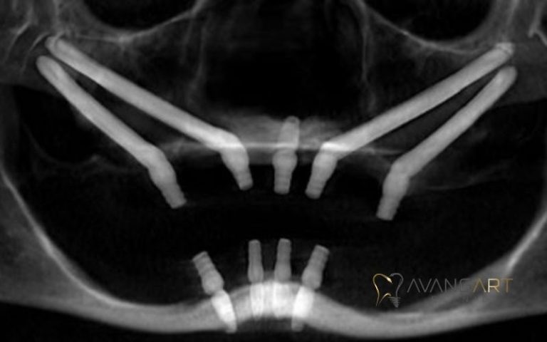 Zygomatic-Implants-x-ray