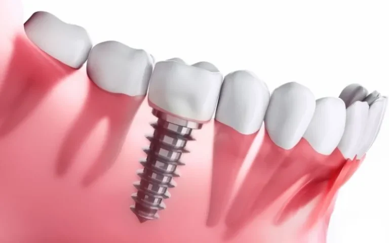 a dental implant with a screw on it