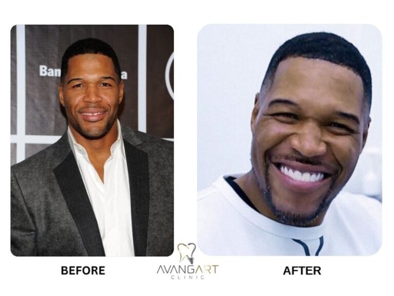 michael strahan tooth gap