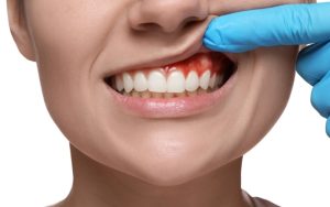 Why Are My Gums White Around My Teeth? Causes, Risks & Treatment Guide
