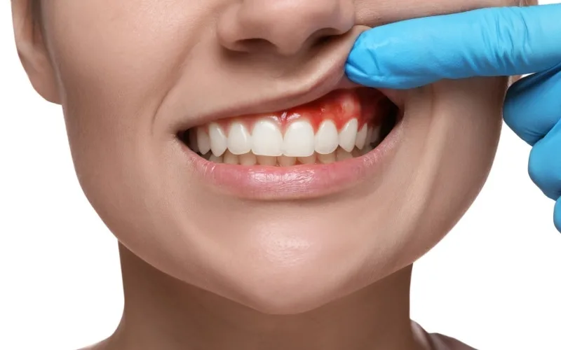 Why Are My Gums White Around My Teeth? Causes, Risks & Treatment Guide