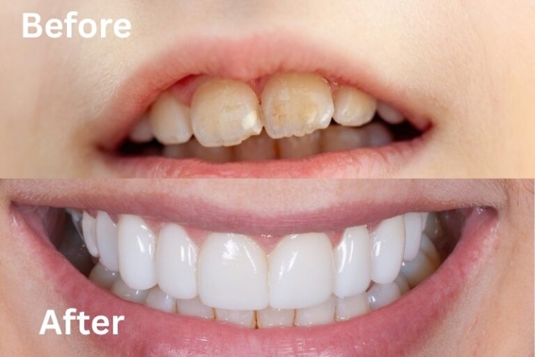 Get Rid Of White Spots On Teeth